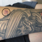Ringworm infection on a black tattoo with redness and scaling