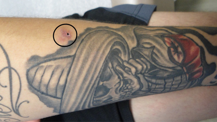 Ringworm infection on a black tattoo with redness and scaling