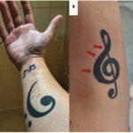 tattooed forearm with urticaria