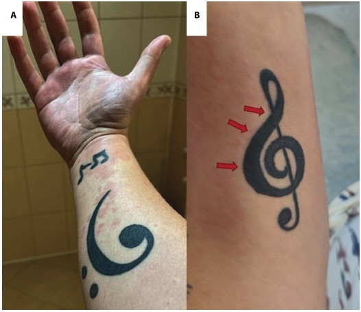 tattooed forearm with urticaria