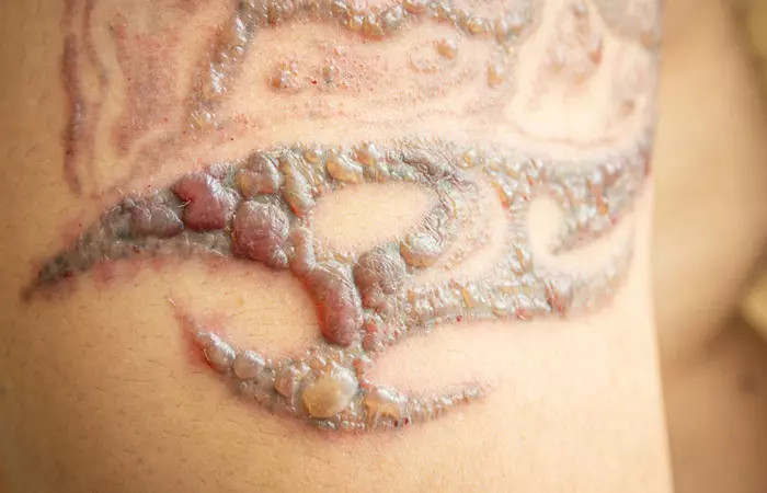Wet scabbing on an old tattoo