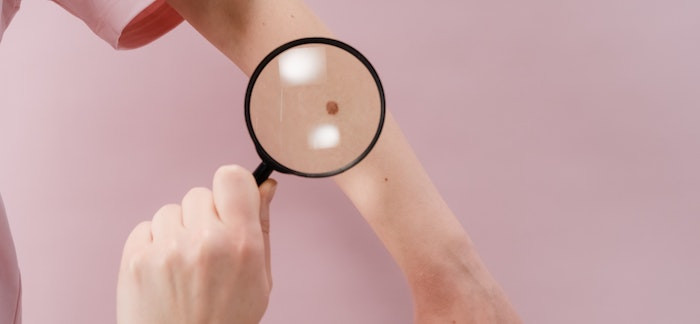 Close-up of a flat mole on skin, indicating potential tattoo area.