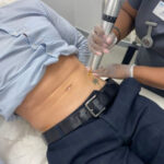 Close up of laser tattoo removal