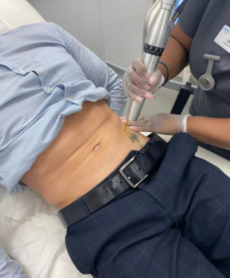 Close up of laser tattoo removal