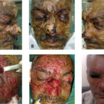 Burn-blast Traumatic Tattoo